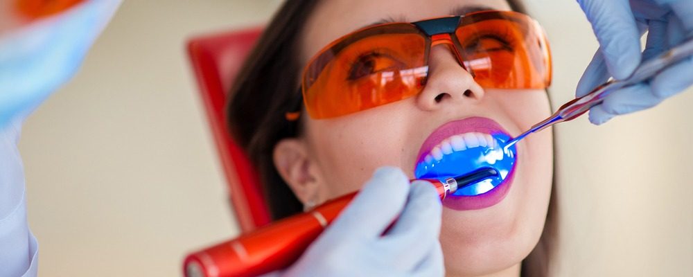 dental-bonding-services