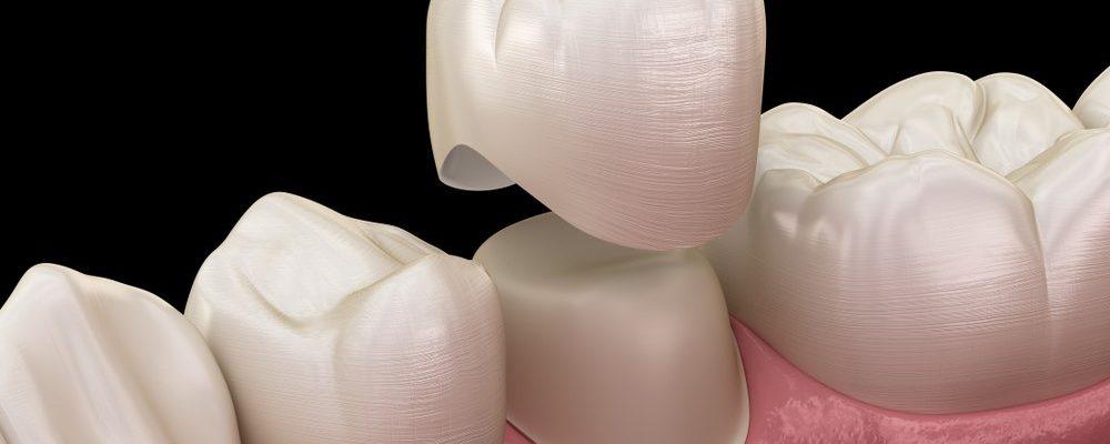 guide-to-dental-crowns